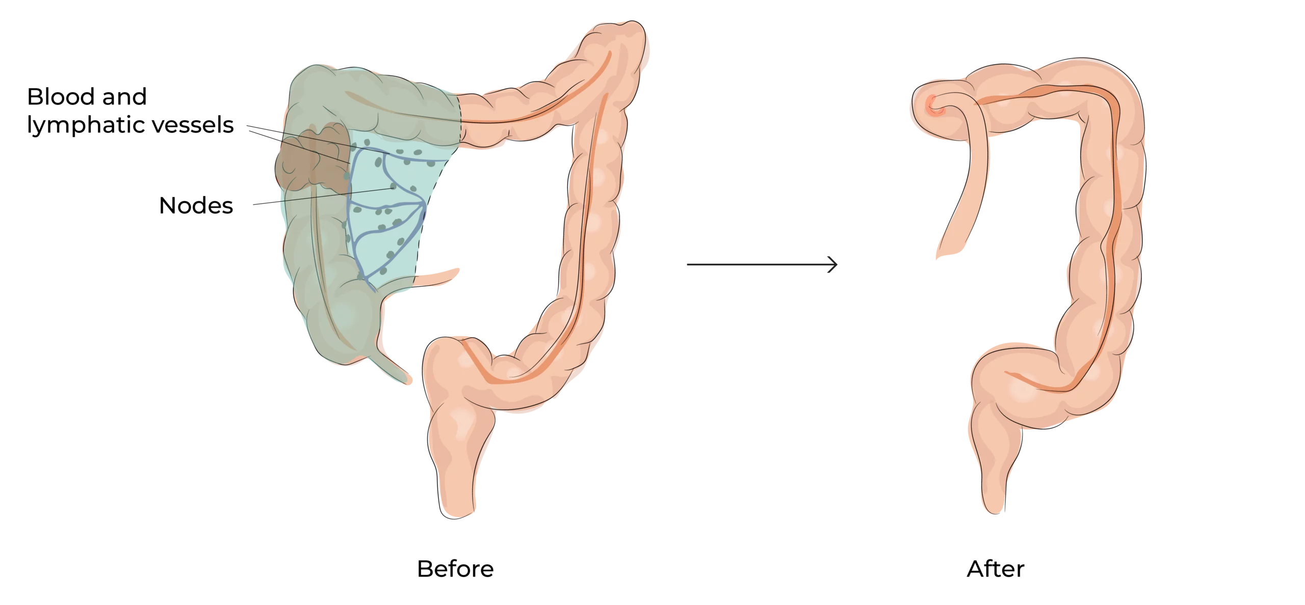 https://coloproctologie.com/wp-content/uploads/2023/10/Right-colectomy-08-scaled.webp