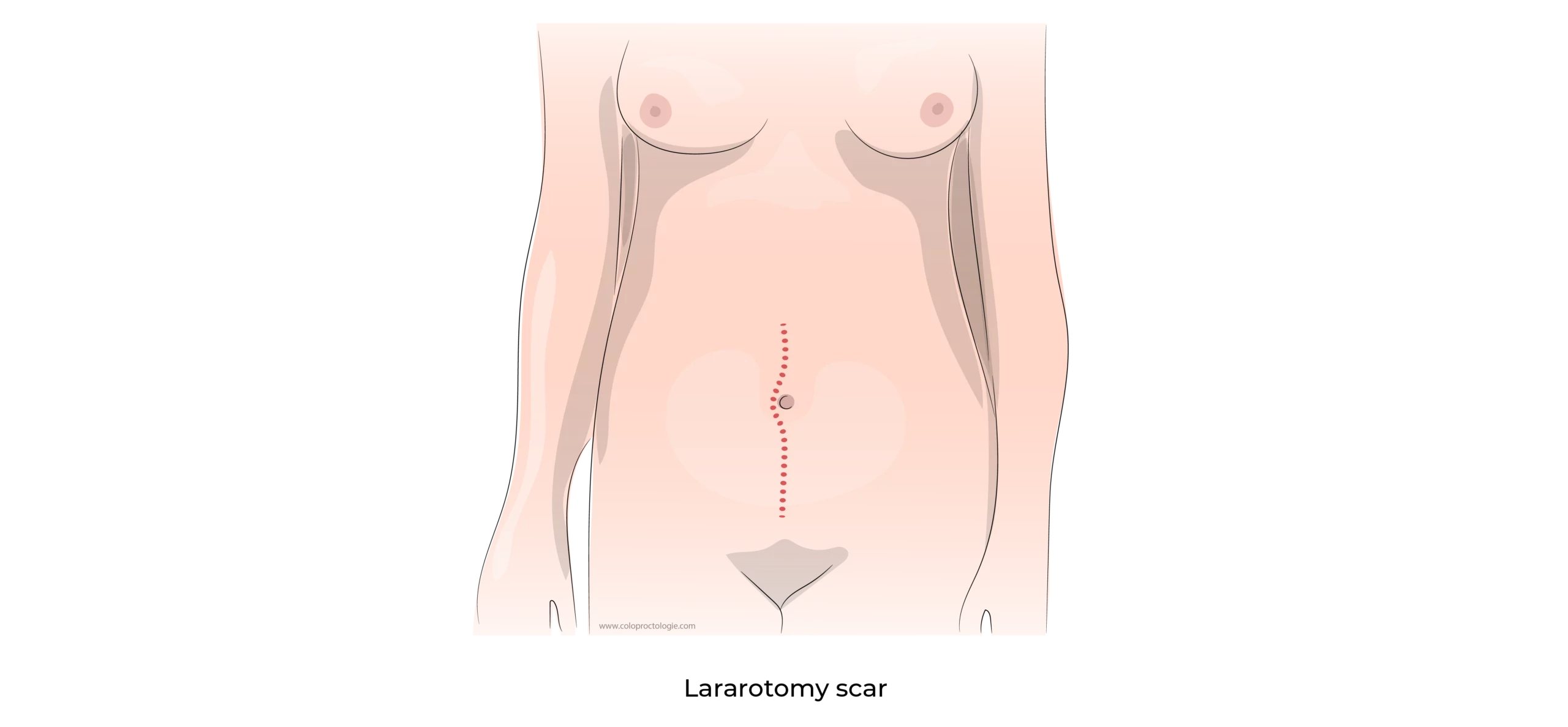 https://coloproctologie.com/wp-content/uploads/2023/10/Right-colectomy-10-scaled.webp