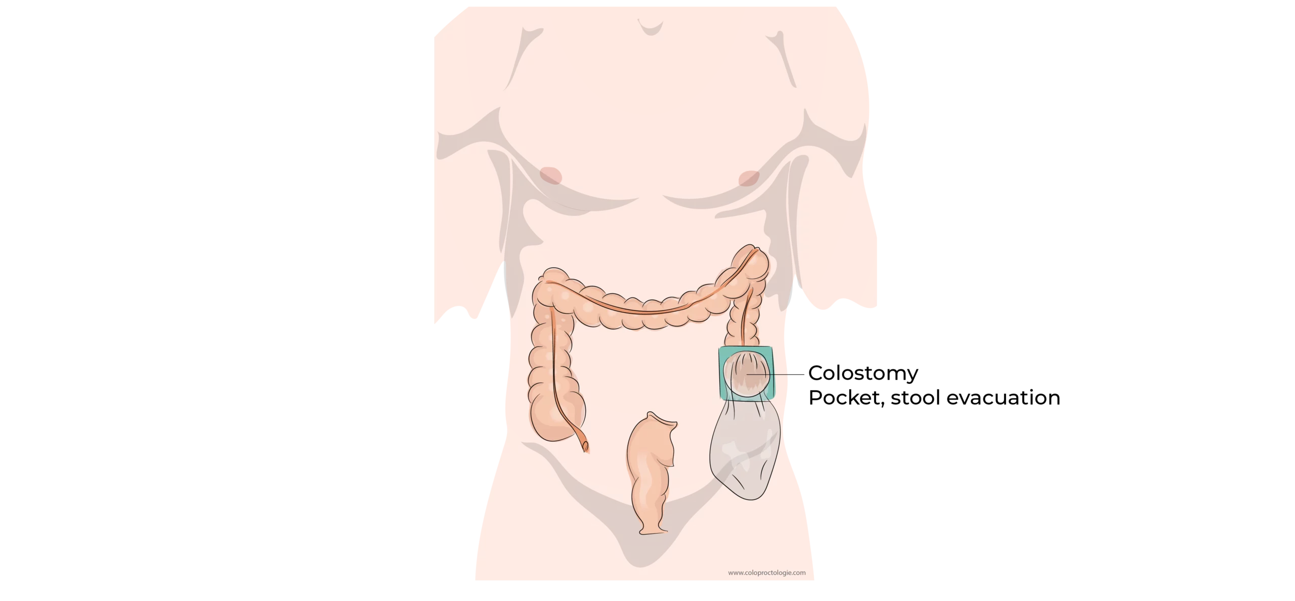 https://coloproctologie.com/wp-content/uploads/2023/10/Right-colectomy-11-scaled.webp