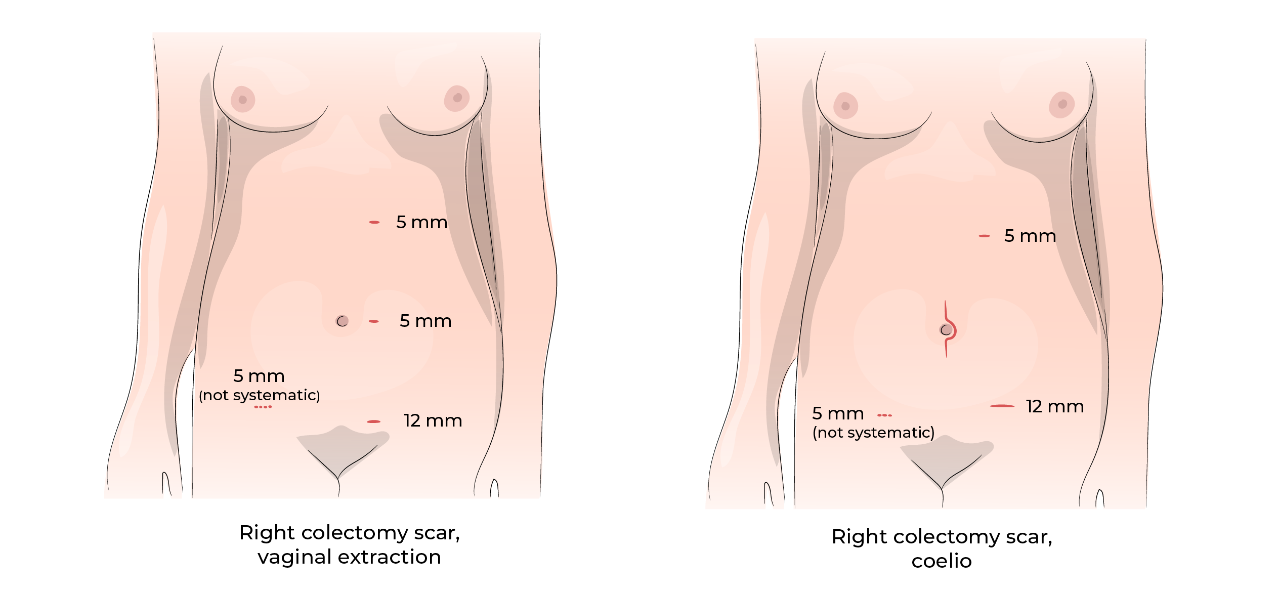 https://coloproctologie.com/wp-content/uploads/2023/10/Right-colectomy-15-09.webp