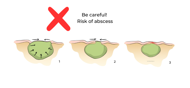 https://coloproctologie.com/wp-content/uploads/2023/10/Risque-abces-en.png