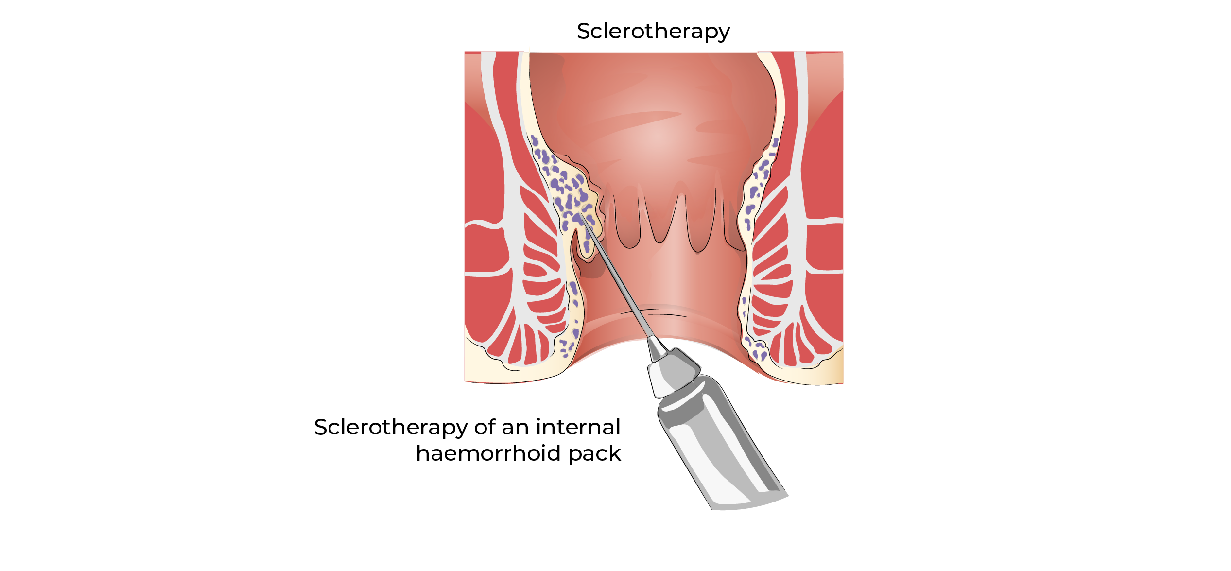 https://coloproctologie.com/wp-content/uploads/2023/10/sclerotherapy-bomans-16.webp