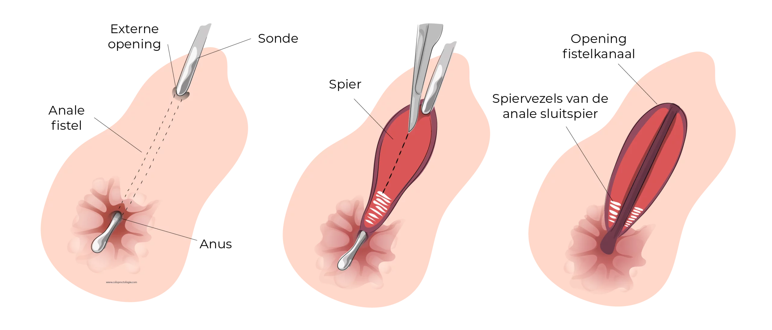 https://coloproctologie.com/wp-content/uploads/2023/11/Fistule-Anale-30-scaled.webp