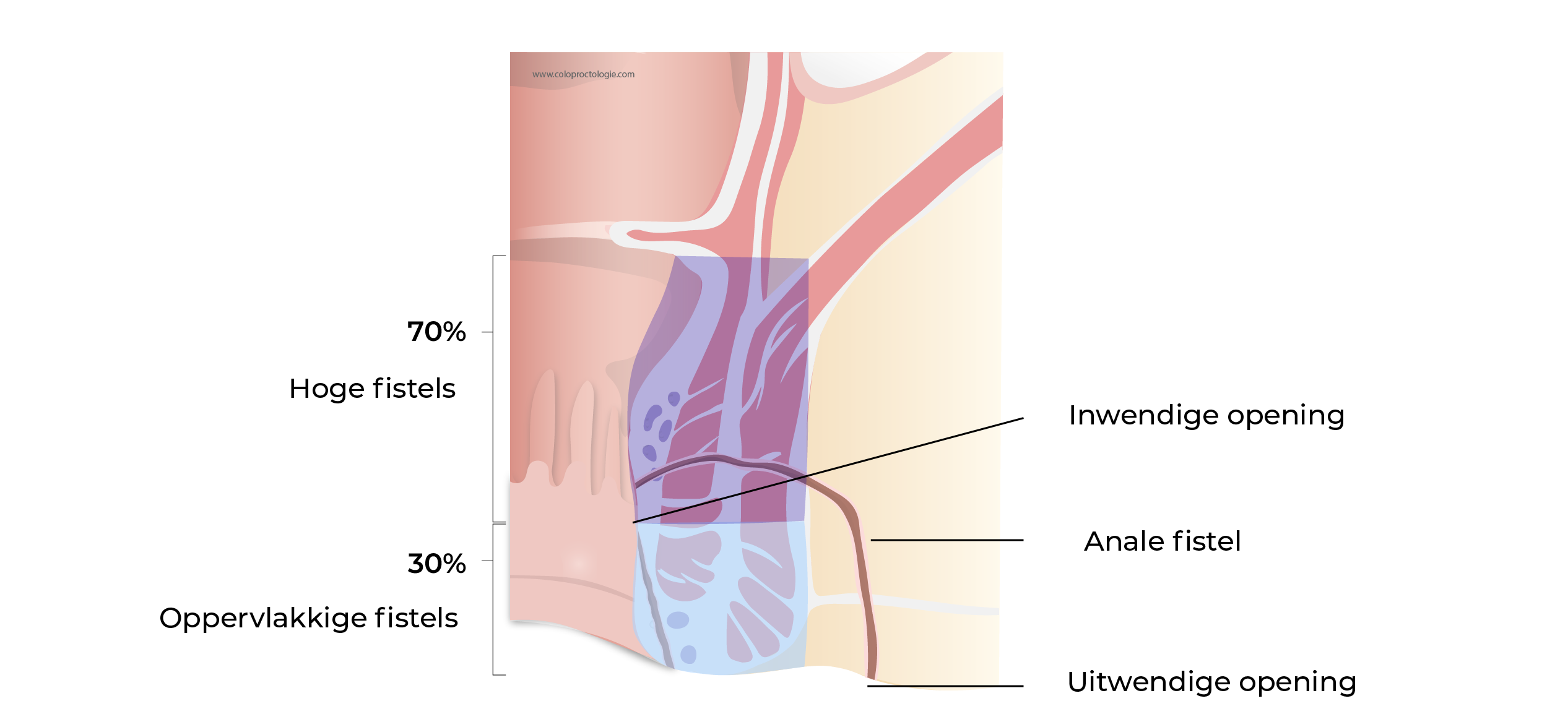 https://coloproctologie.com/wp-content/uploads/2023/11/Fistule-Anale-32.webp