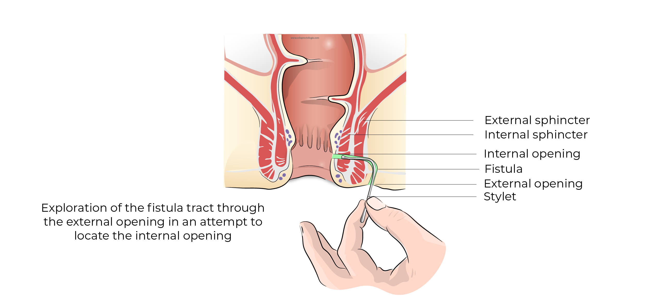 https://coloproctologie.com/wp-content/uploads/2023/11/Fistule-Anale-41.webp