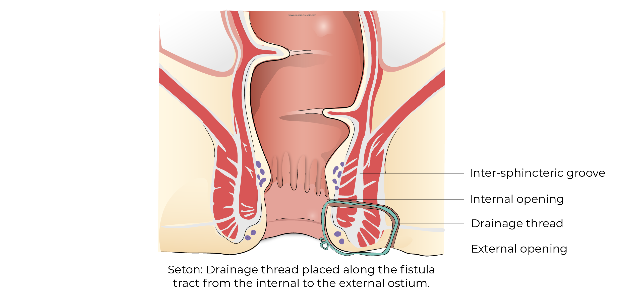 https://coloproctologie.com/wp-content/uploads/2023/11/Fistule-Anale-42.webp