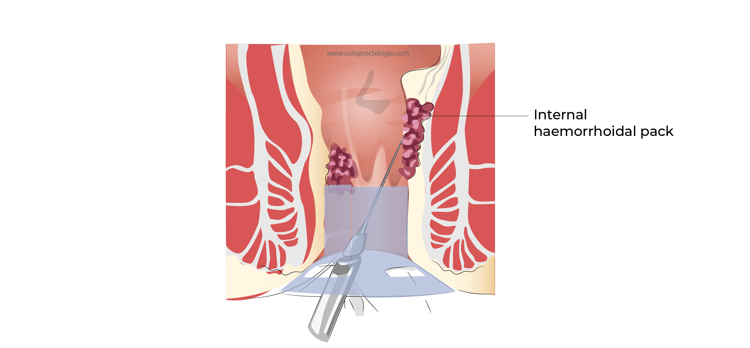 https://coloproctologie.com/wp-content/uploads/2023/11/Hemorroide-45.webp
