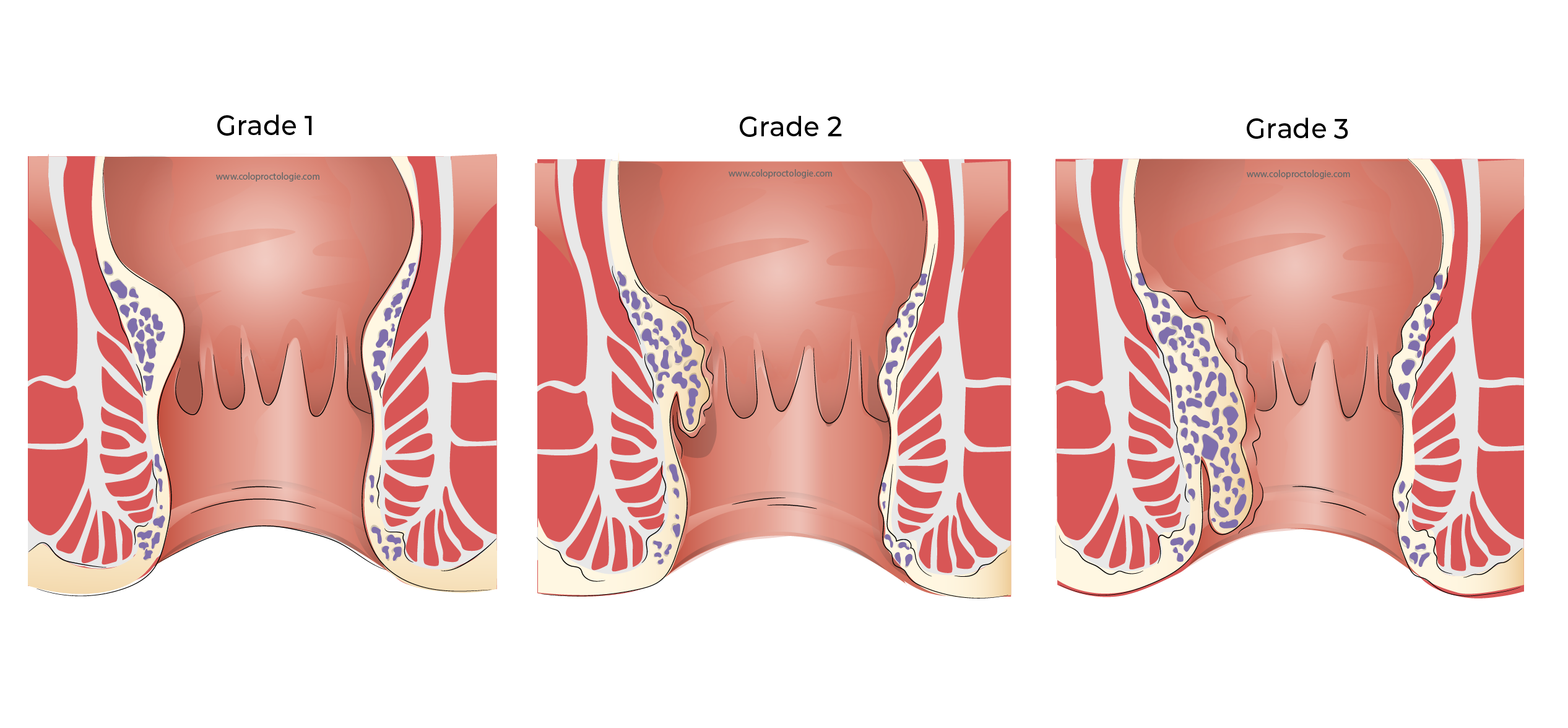 https://coloproctologie.com/wp-content/uploads/2023/11/Hemorroide-47-1.webp