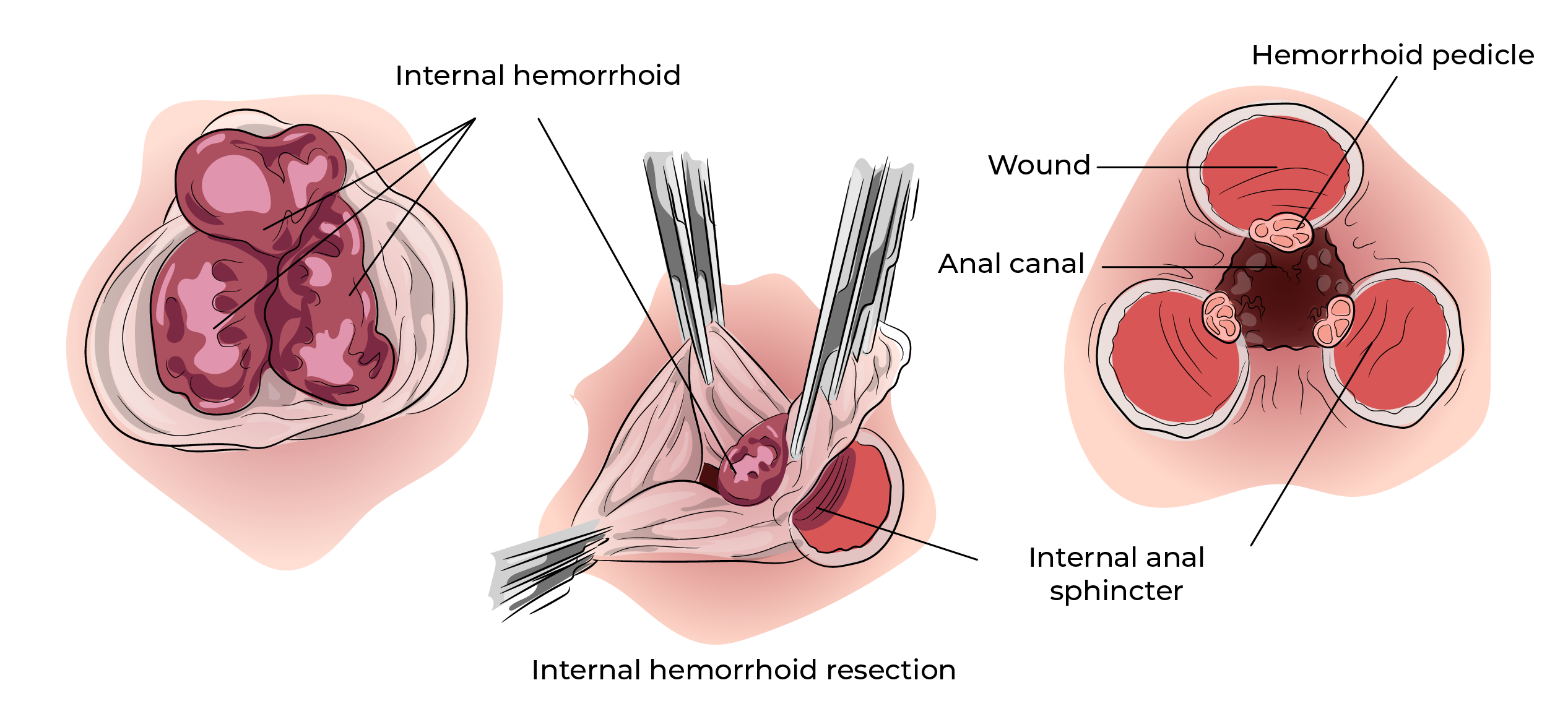 https://coloproctologie.com/wp-content/uploads/2023/11/Hemorroide-51.webp
