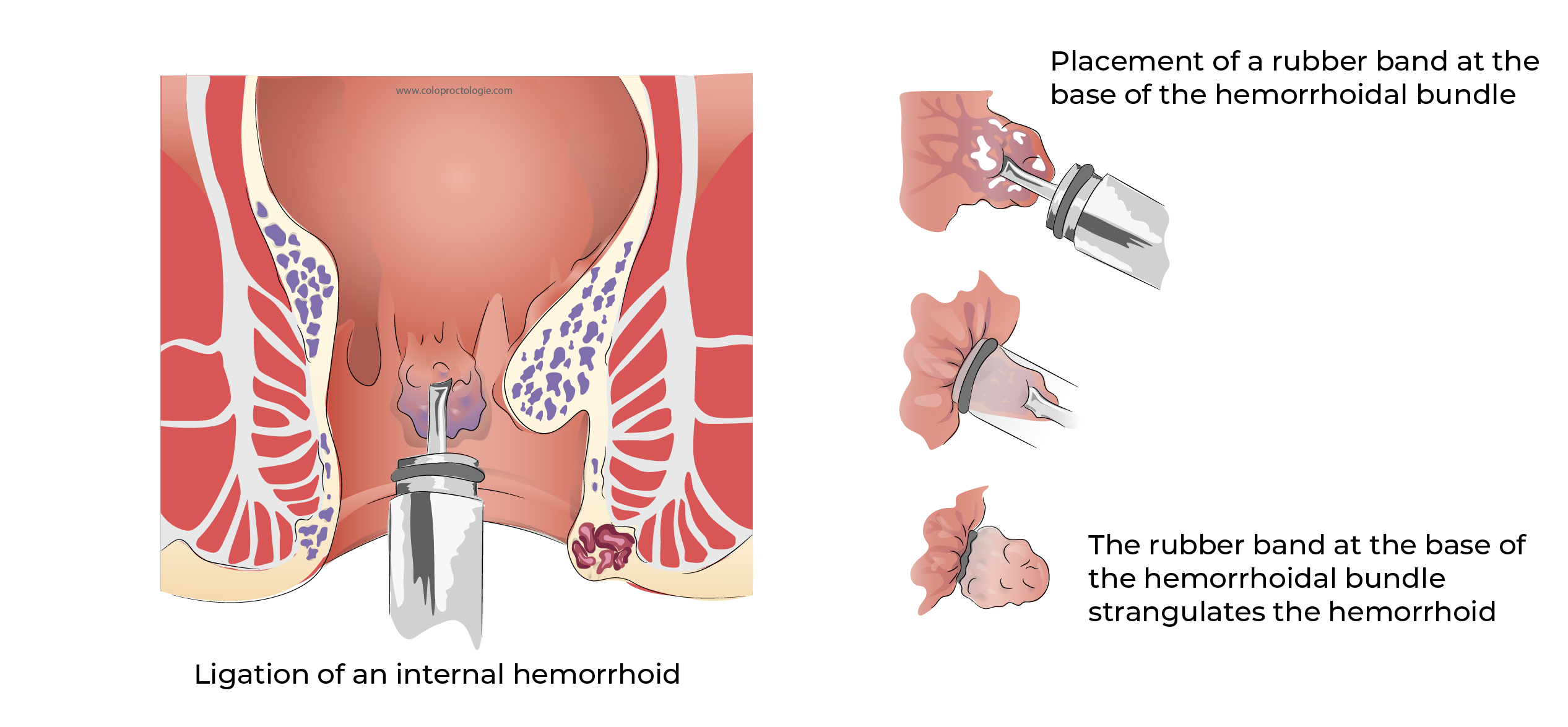 https://coloproctologie.com/wp-content/uploads/2023/11/Hemorroide-57.webp