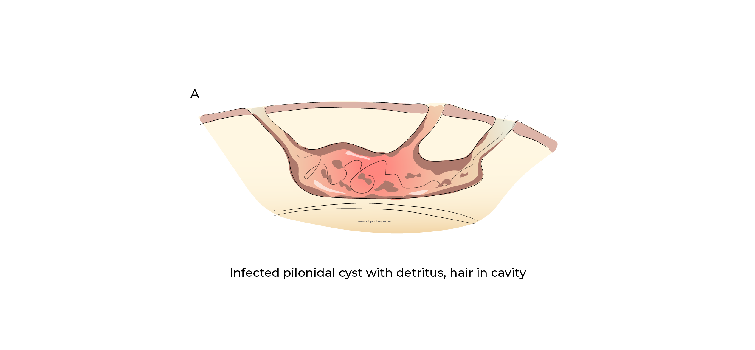 https://coloproctologie.com/wp-content/uploads/2023/11/Kyste-Pilonidale-Illustrations-english-21.webp