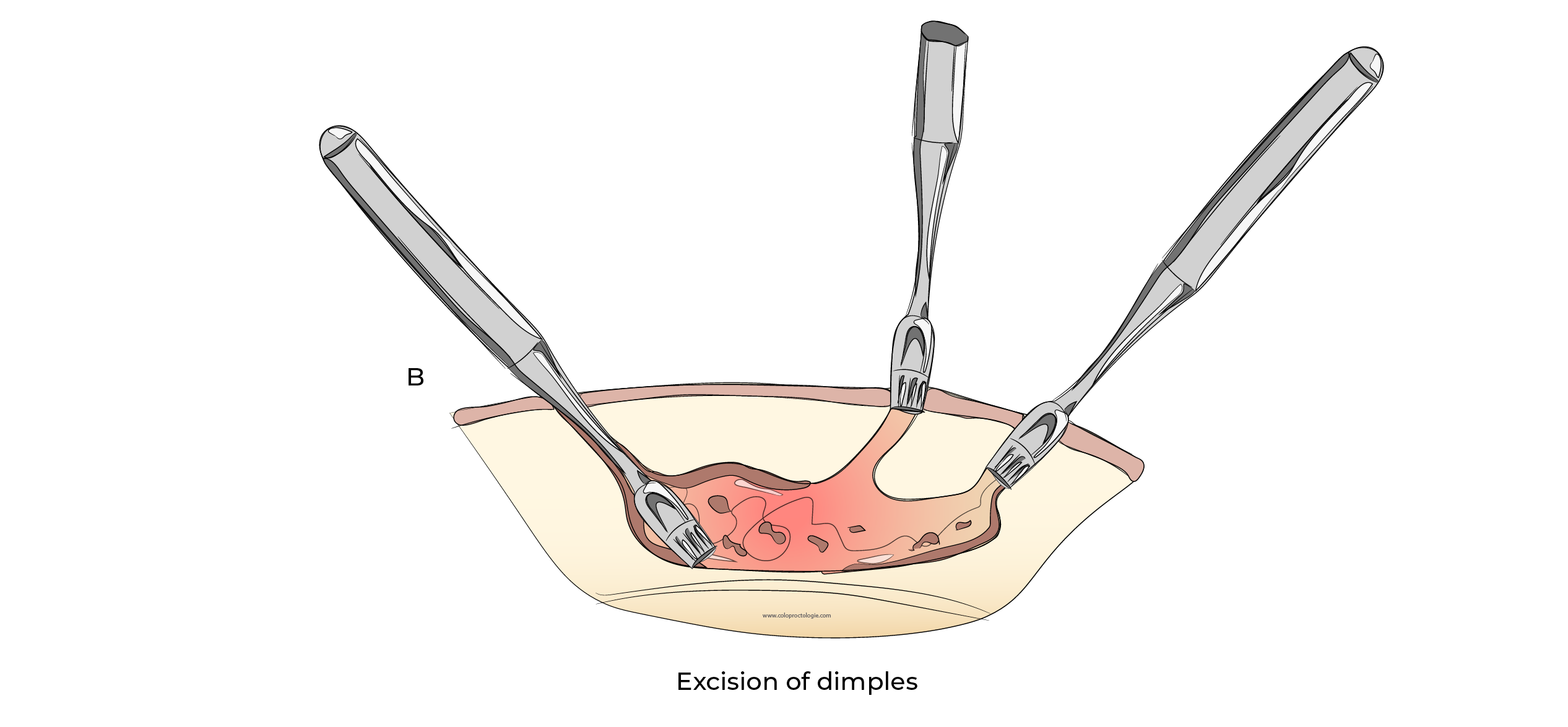 https://coloproctologie.com/wp-content/uploads/2023/11/Kyste-Pilonidale-Illustrations-english-22.webp