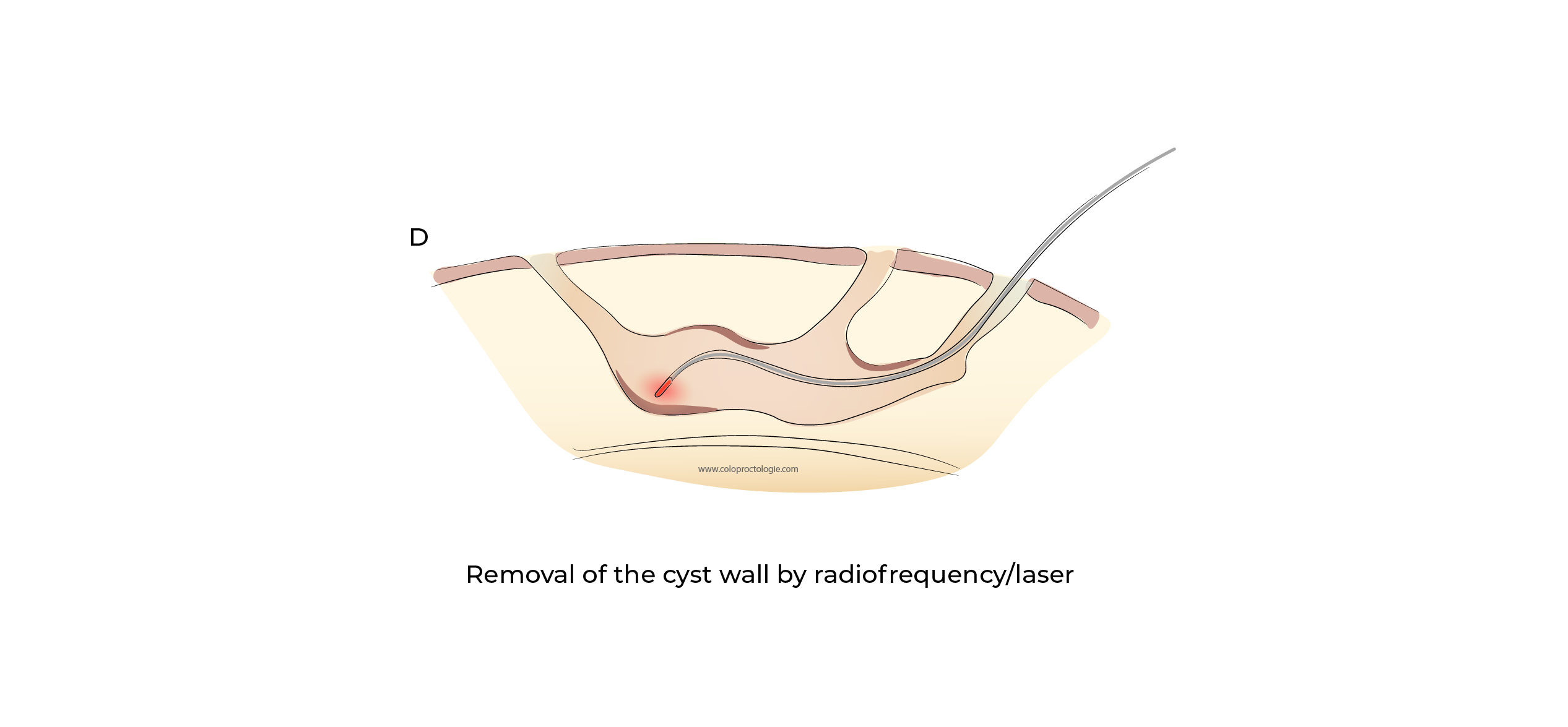 https://coloproctologie.com/wp-content/uploads/2023/11/Kyste-Pilonidale-Illustrations-english-24.webp