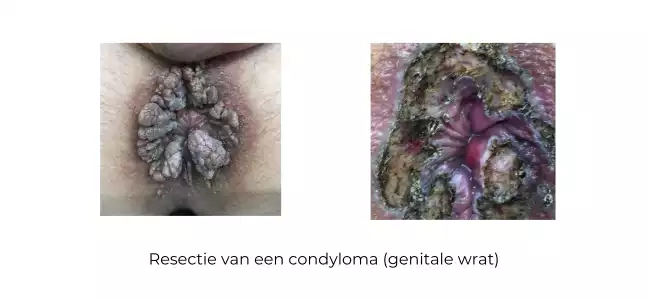 https://coloproctologie.com/wp-content/uploads/2023/11/genitale-wrat-Bomans.webp