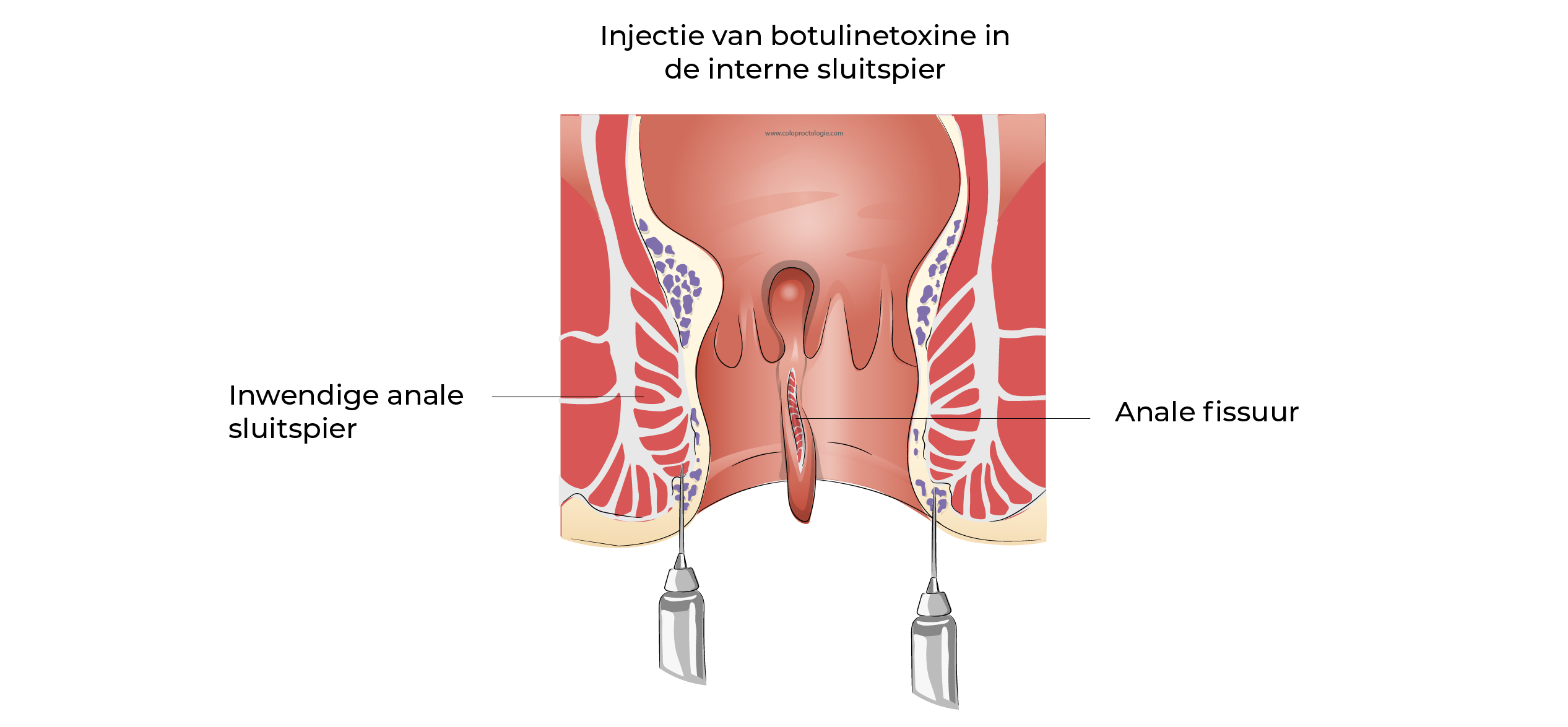 https://coloproctologie.com/wp-content/uploads/2023/12/Fissure-Anale_-25.webp
