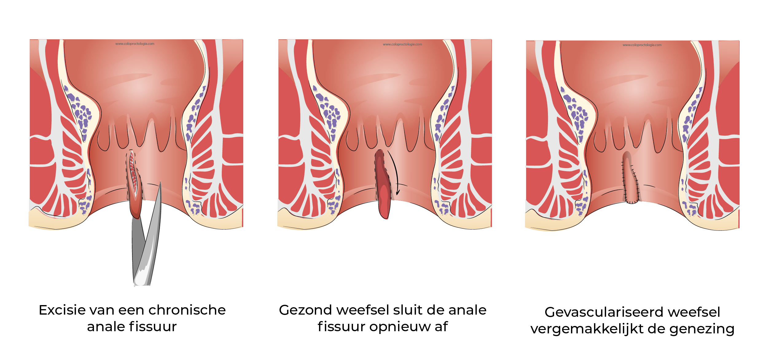 https://coloproctologie.com/wp-content/uploads/2023/12/Fissure-Anale_-29.webp