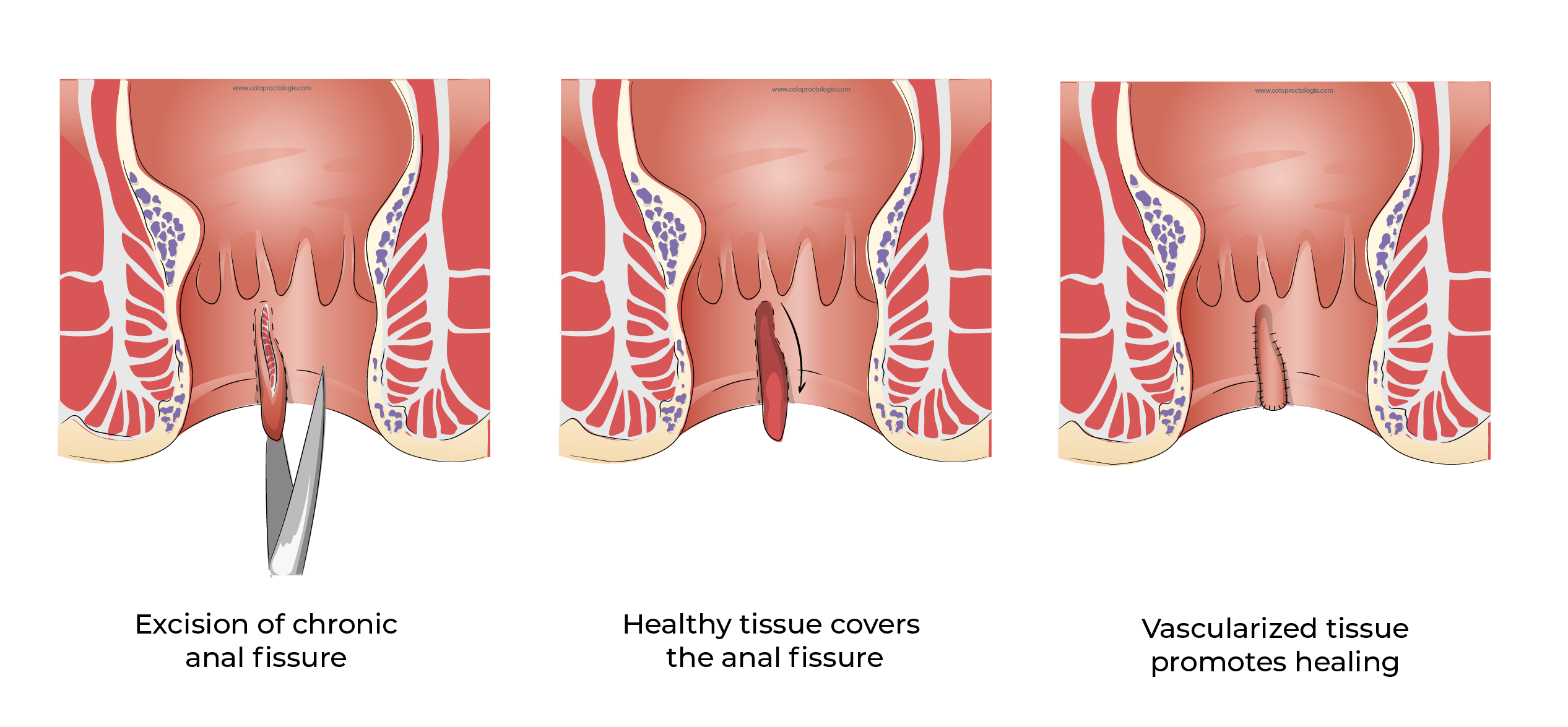 https://coloproctologie.com/wp-content/uploads/2023/12/Fissure-Anale_-30.webp