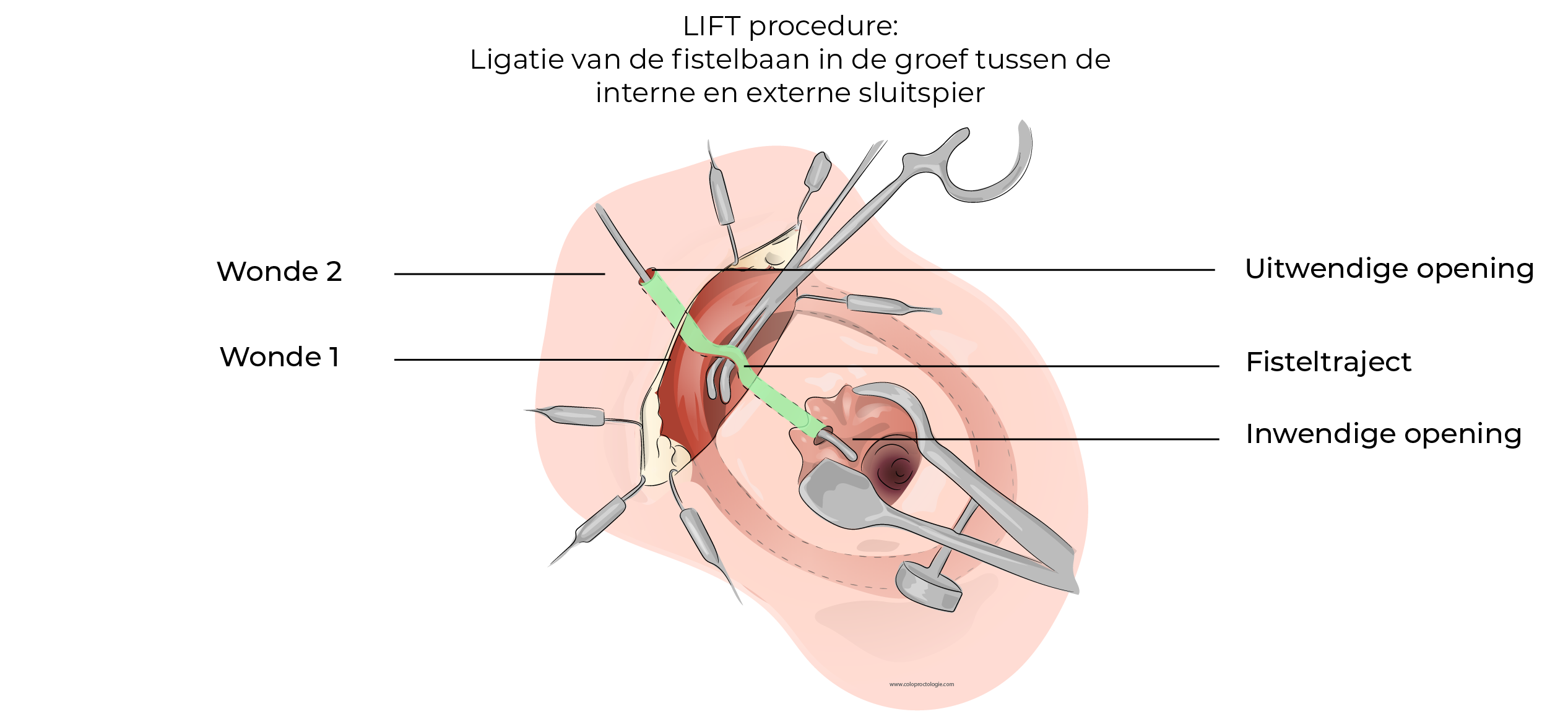 https://coloproctologie.com/wp-content/uploads/2023/12/Fistule-Anale-38.webp