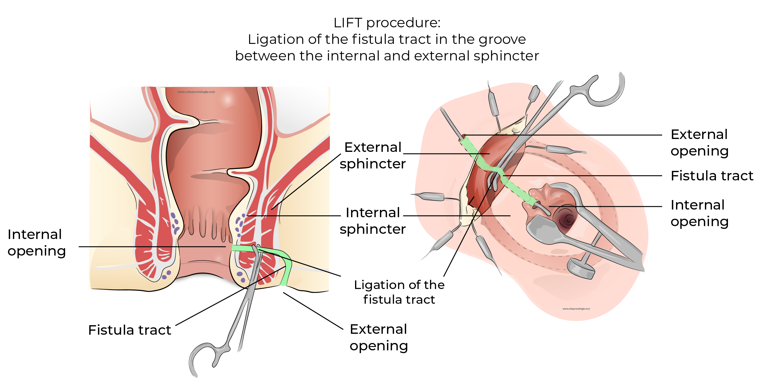 https://coloproctologie.com/wp-content/uploads/2023/12/Fistule-Anale-39.webp