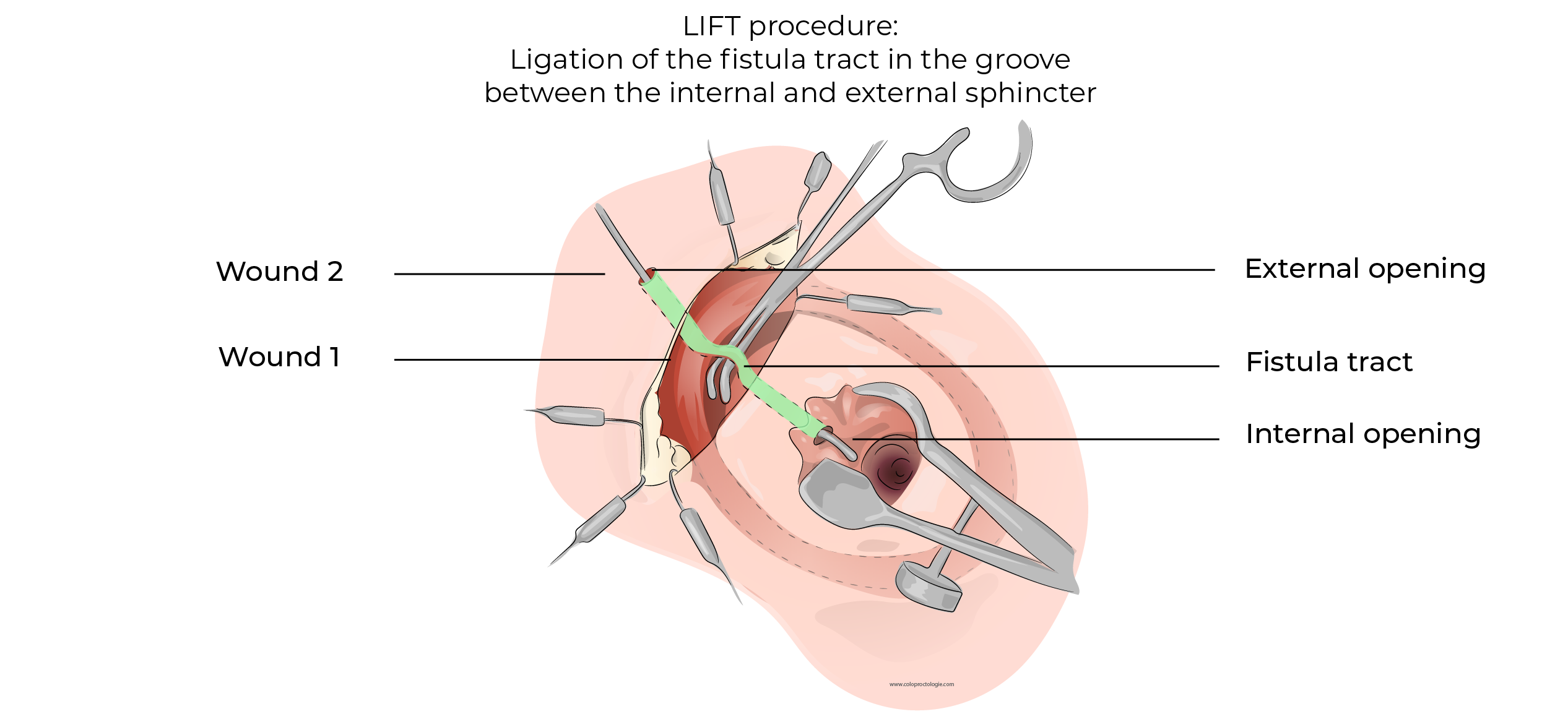 https://coloproctologie.com/wp-content/uploads/2023/12/Fistule-Anale-40.webp