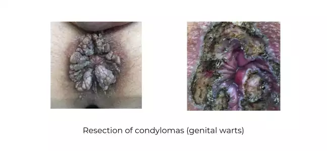https://coloproctologie.com/wp-content/uploads/2024/06/Resection-of-condylomas-_genital-warts_-Bomans-1.webp